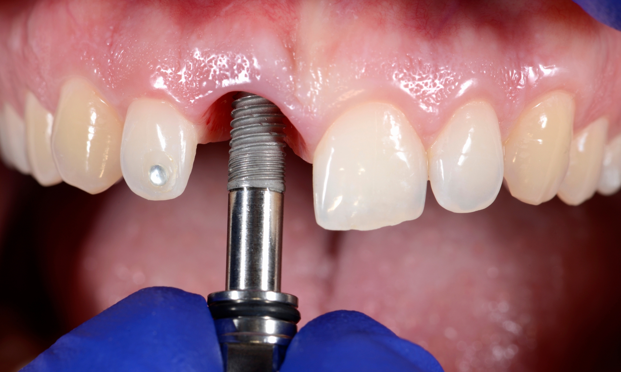 proceso de colocación de implante dental