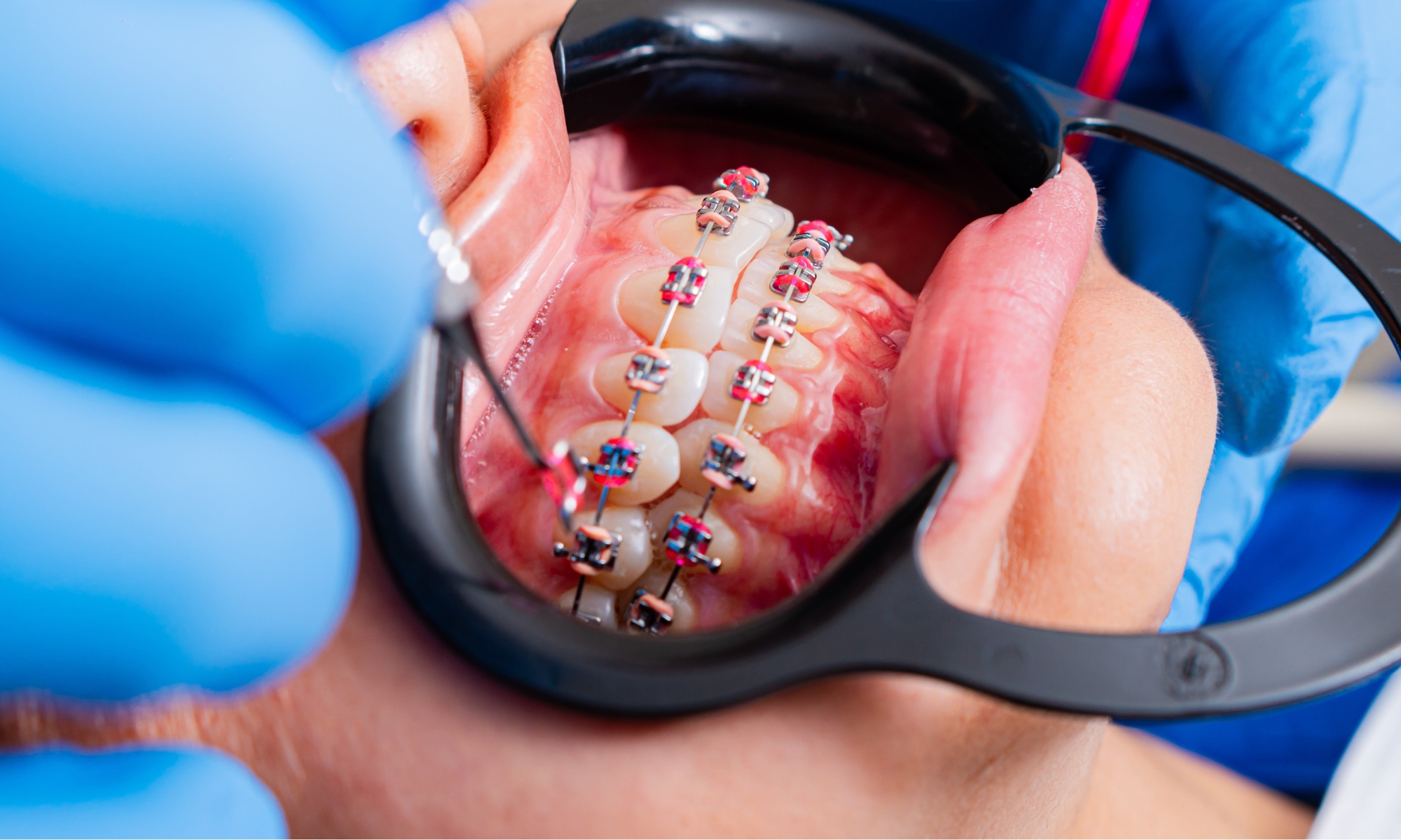 ortodoncia invisible en clínica dental de Granada