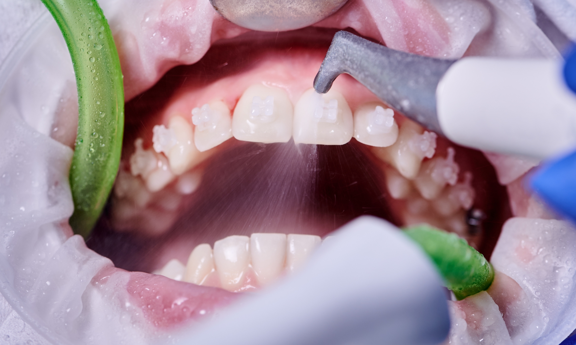 Protocolo MIP de higiene dental