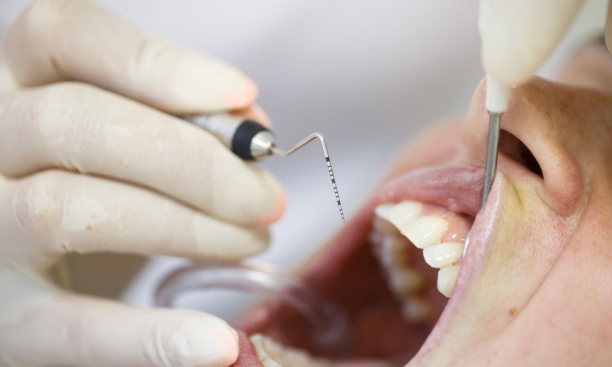 periodoncia en clínica de Granada